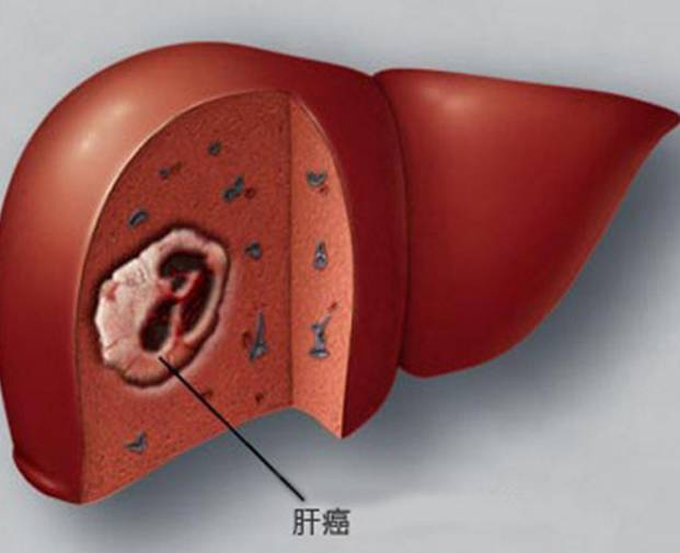 重庆中医治疗肝癌怎么样？