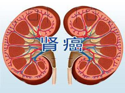 重庆中医治疗肾癌的优势特色