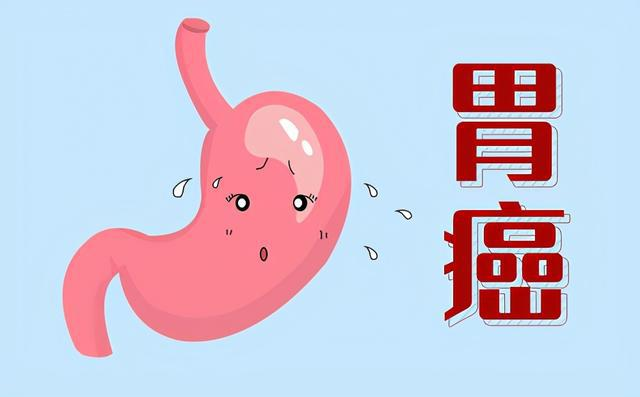 肿瘤专家石毓斌:为什么会得胃癌？实际上是幽门螺杆菌感染！