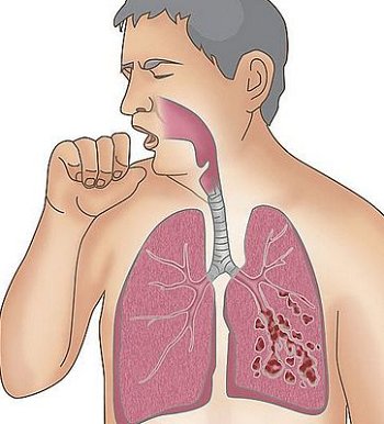 中医如何看待肺纤维化?这些优势你知道吗?