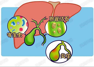 重庆中医院肿瘤专家石毓斌整理的胆管癌晚期护理小贴士
