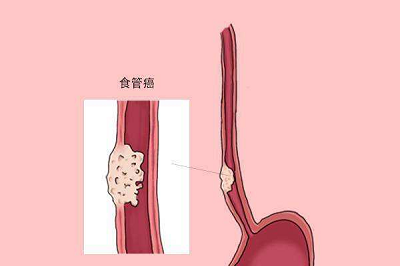 重庆中医肿瘤医师:关于食管癌你了解多少呢?平时该如何自查呢?
