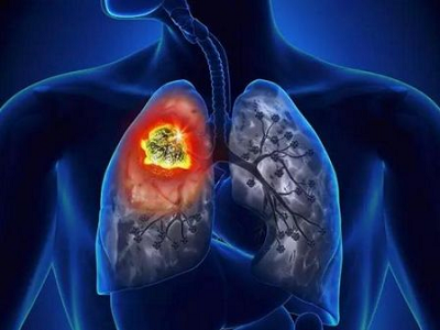 重庆中医肿瘤医师:肺癌为什么增长这么快?有哪些重要原因导致的