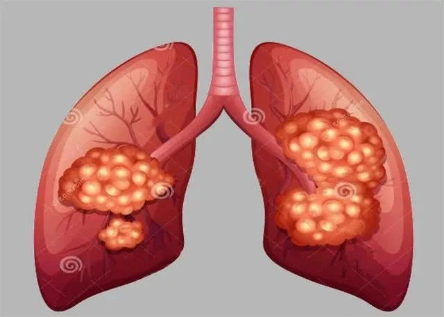 重庆中医肺癌专家:肺癌为什么被称为第一癌症