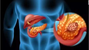 重庆中医治疗胰腺癌好的专家:胰腺癌和糖尿病在治疗前应区分清楚。