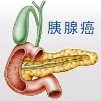 重庆中医肿瘤科医院科普|胰腺癌需要检查哪些项目