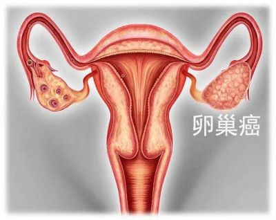 重庆老中医石毓斌:卵巢癌有什么危害?中医治疗卵巢癌优势是什么？