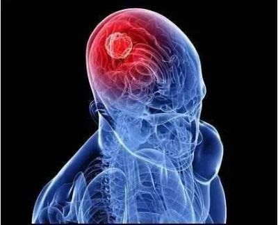 重庆肿瘤老中医:什么是脑胶质瘤?又该选择什么治疗方式呢