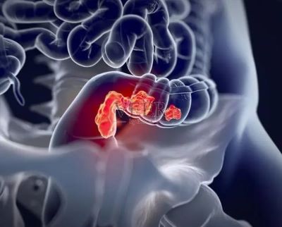 排便出现哪些“异常”,说明是肠道开始癌变呢