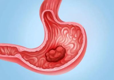 胃癌不是悄无声息,4个因素会诱发胃癌