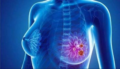乳腺癌手术后,复发和转移的可能性也是比较高的。