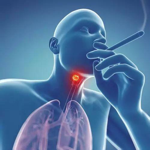 关于喉癌的症状 你知道多少？