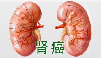 肾癌怎么治？肾癌晚期可以调理吗？
