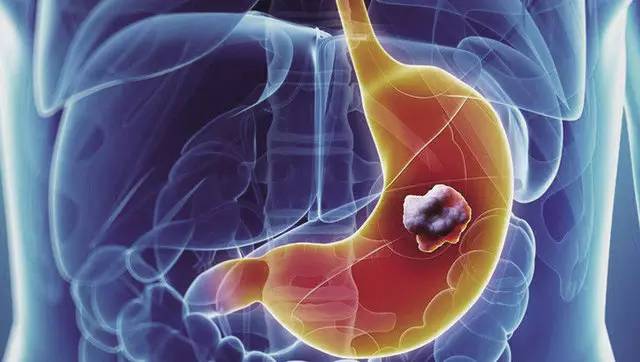 中医能检查出胃癌吗？如何诊断胃癌？
