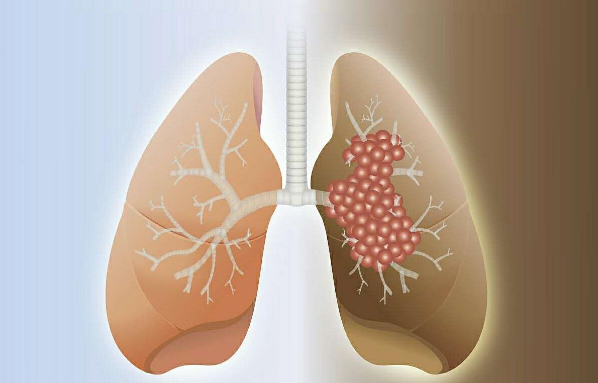 咳嗽也可能是肺癌 这些人群咳嗽需要特别关注！